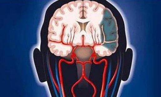 為什么會出血性腦梗死？出血性腦梗死有哪些并發癥？