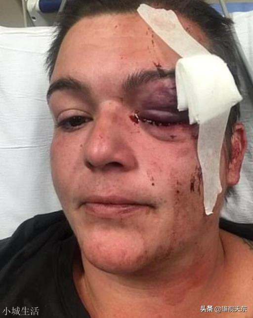 美国女记者遭警方射中眼球爆裂,一只眼永久失明,对此你怎么看?