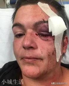 美国女记者遭警方射中眼球爆裂,一只眼永久失明,对此你怎么看?