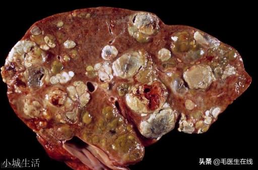 一高中同学患上肝癌，所有至亲经济都被拖垮，敢劝他家人放弃吗？