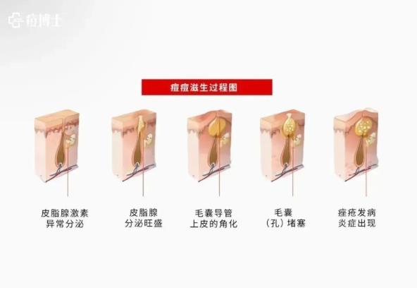 细胞在毛囊漏斗部变身痘痘——细说细胞祛痘之四 博士说痘||直击痘痘的老巢