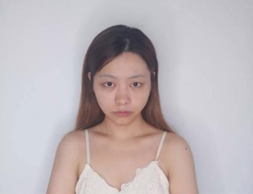 厦门薇格整形医院割双眼皮技术:还您一双明亮的眼睛