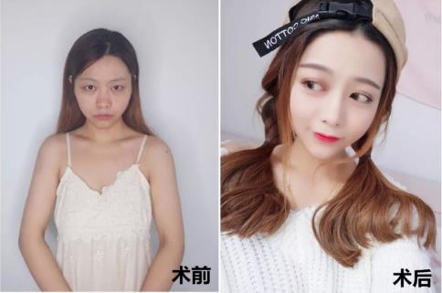 厦门薇格整形医院割双眼皮技术:还您一双明亮的眼睛