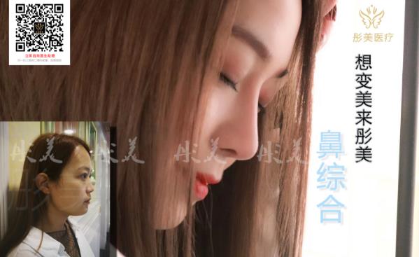 改變未來從變美開始 北京彤美隆鼻效果怎么樣