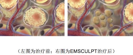 BTL公司Emsculpt美修斯磁波塑肌，是如何做到增肌又减脂的