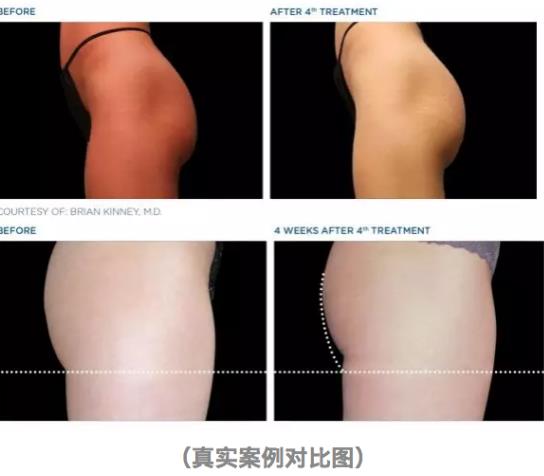 BTL公司Emsculpt美修斯磁波塑肌，是如何做到增肌又减脂的