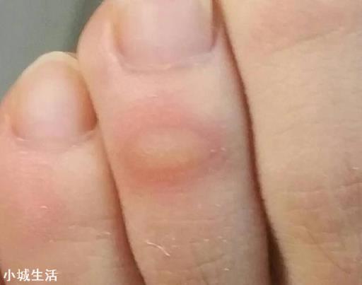 跑步中如何有效避免磨泡？