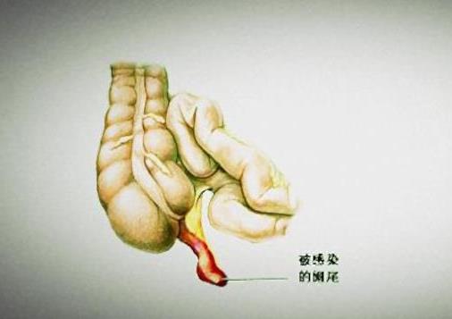 什么是急性阑尾炎？急性阑尾炎严重吗？