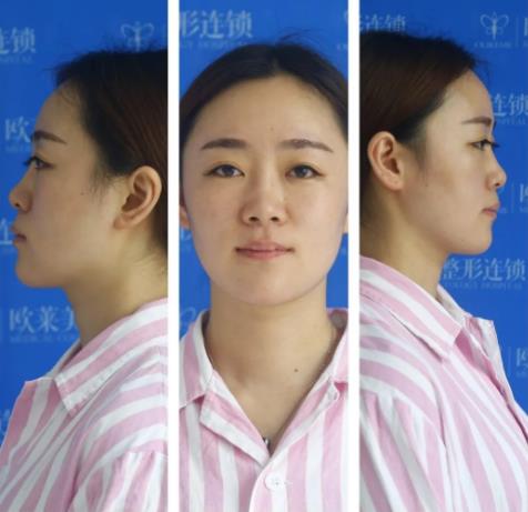 义乌欧莱美鼻整形案例免费招募活动火热进行中!