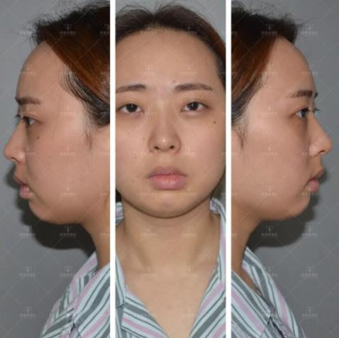 义乌欧莱美鼻整形案例免费招募活动火热进行中!