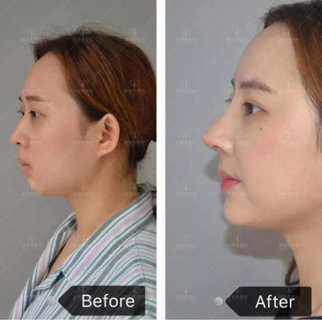 义乌欧莱美鼻整形案例免费招募活动火热进行中!