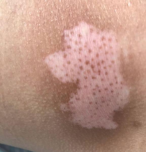 身上出现白斑了,就一定是白癜风吗?如何应对?