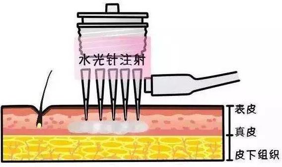 北京伊美尔紫竹医院：注射水光针多少钱