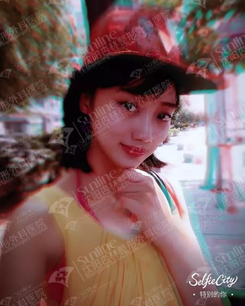 沈阳杏林整形医院玻尿酸隆鼻如何123123