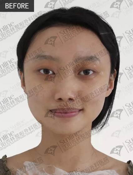 沈阳杏林整形医院玻尿酸隆鼻如何123123