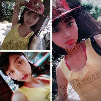 沈阳杏林整形医院玻尿酸隆鼻如何123123