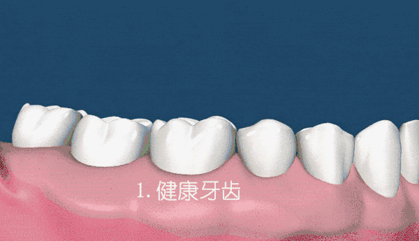 怎么防止牙龈萎缩加重 如何防止牙龈萎缩