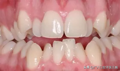 怎么防止牙龈萎缩加重 如何防止牙龈萎缩