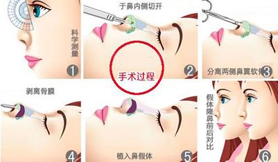 煤医整形王驰主任:并不是什么人都适合鼻综合手术