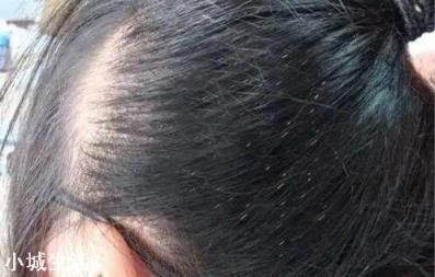 七八十年代人身上的虱子是怎么来的？