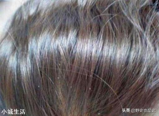 七八十年代人身上的虱子是怎么来的？