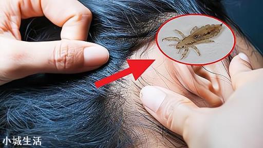 七八十年代人身上的虱子是怎么来的？