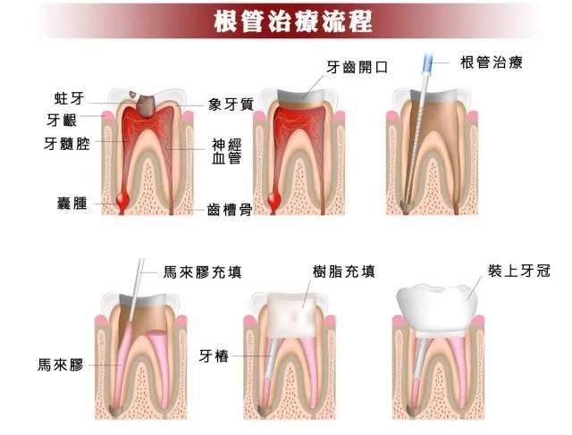 根管治疗一颗全部费用 牙齿做根管治疗多少钱