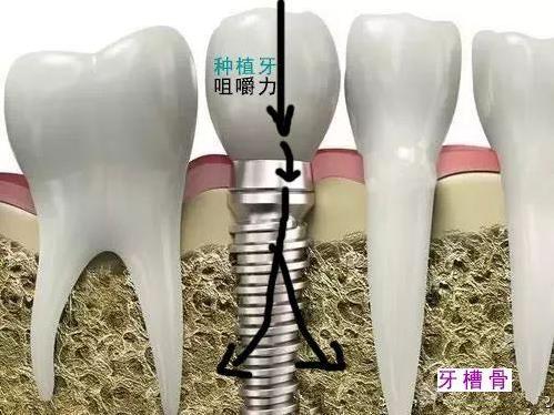 全民爱牙公益行动种植牙与陶瓷牙哪个好