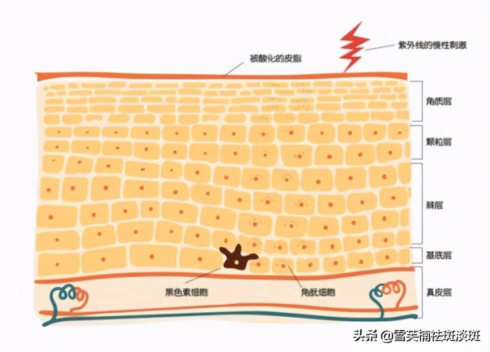 黄褐斑是怎么样形成的？ 黄褐斑是什么原因