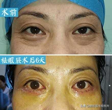 大概费用 眼袋多少钱