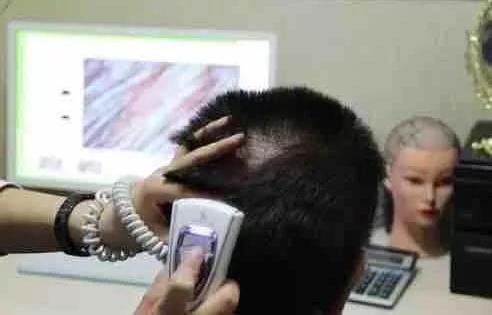 毛囊检测的具体步骤是什么样的？ 嘉兴莱森植发可信吗