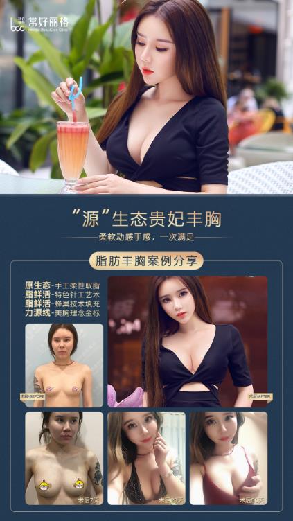北京常好丽格第四季瘦人脂肪丰胸案例招募盛大开启！