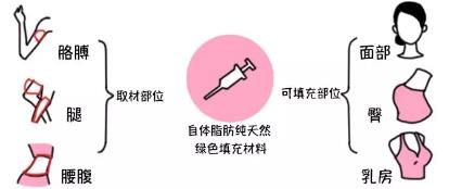 让你轻松塑美拥有魔鬼身材 宁波薇琳自体脂肪好不好