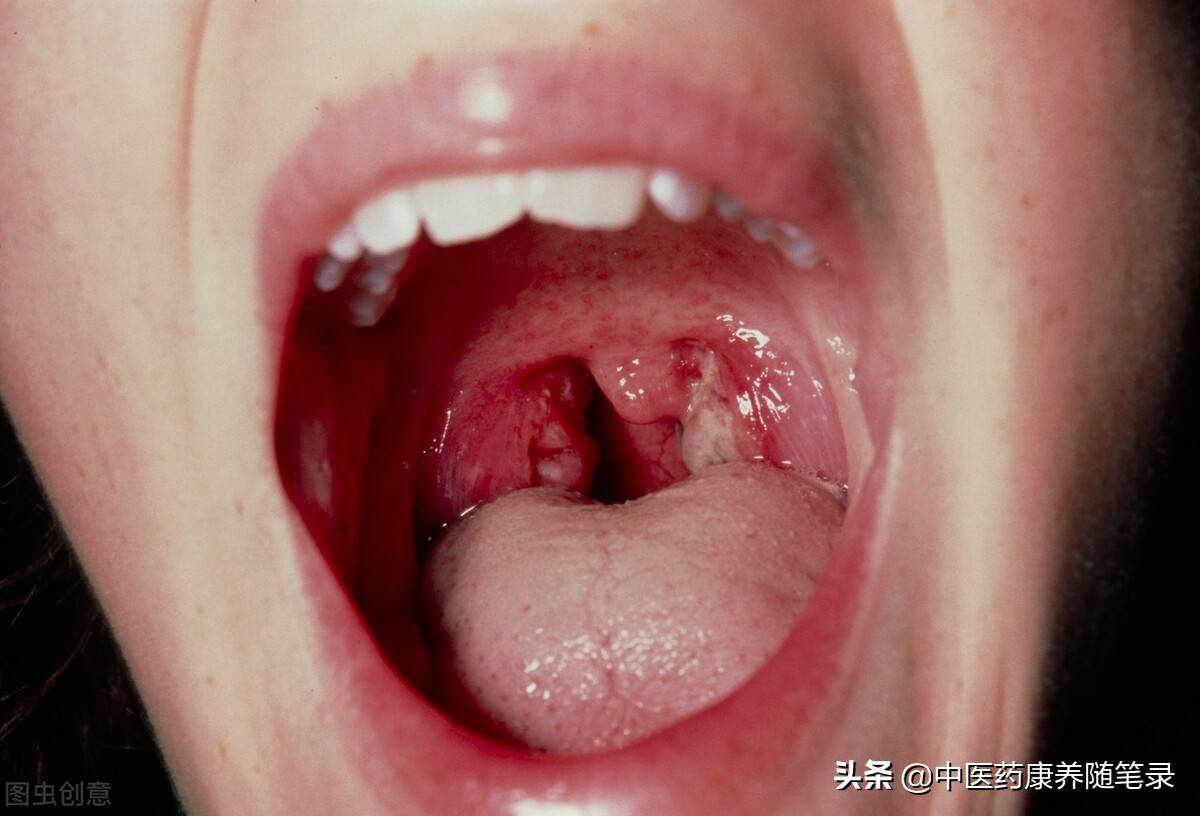慢性扁桃体炎的防治 慢性扁桃体炎