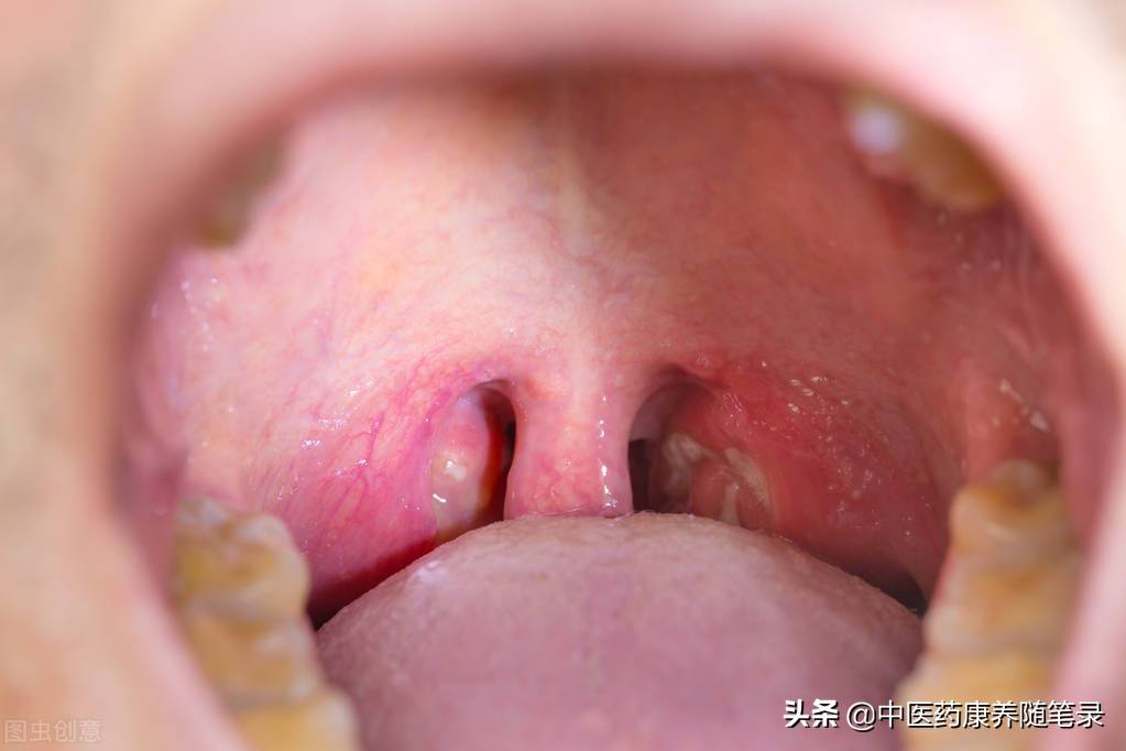 慢性扁桃体炎的防治 慢性扁桃体炎