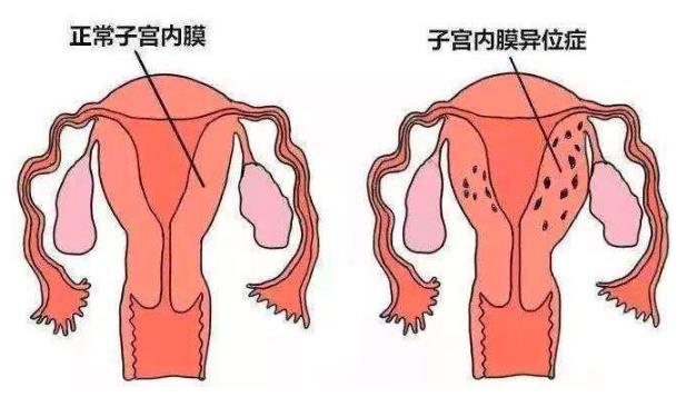了解地诺孕素作用于异位症的原理,针对性治疗才有效