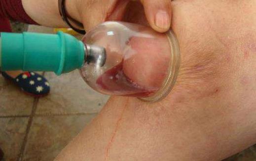膝盖积水可以热敷吗？怎么预防膝盖积水？