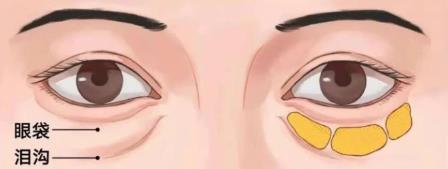 搞清區(qū)別對癥下藥告別眼袋困擾！ 京典麗園不開刀去眼袋