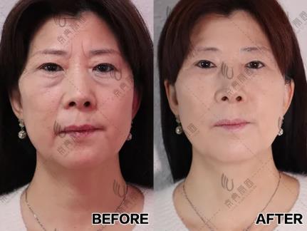 搞清區(qū)別對癥下藥告別眼袋困擾！ 京典麗園不開刀去眼袋