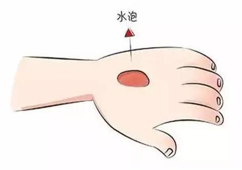 科学处置烧烫伤方法 烫伤的水泡能挑破吗