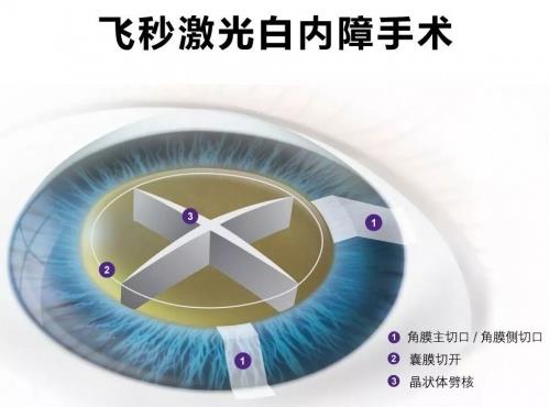 助力老年朋友畅享“睛”彩年华普瑞眼科举办关爱中老年眼健康公益活动