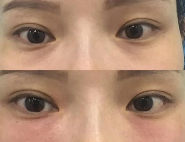 让您更美一点 厦门薇格医院做眼部整形专业吗