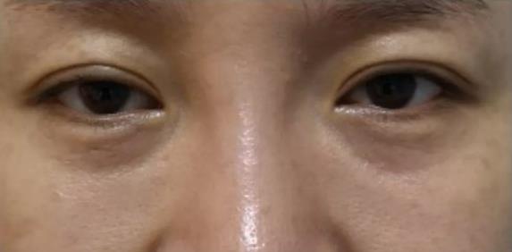让您更美一点 厦门薇格医院做眼部整形专业吗