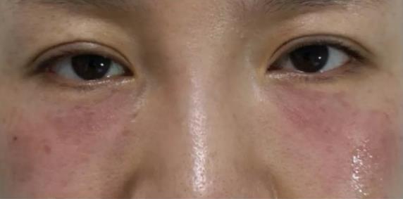 让您更美一点 厦门薇格医院做眼部整形专业吗