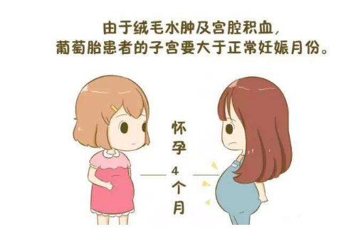什么是葡萄胎有什么症状