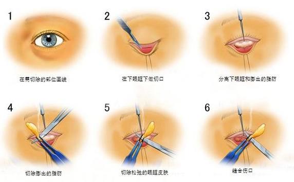 西安祛眼袋哪家好？艾薇美给你答案