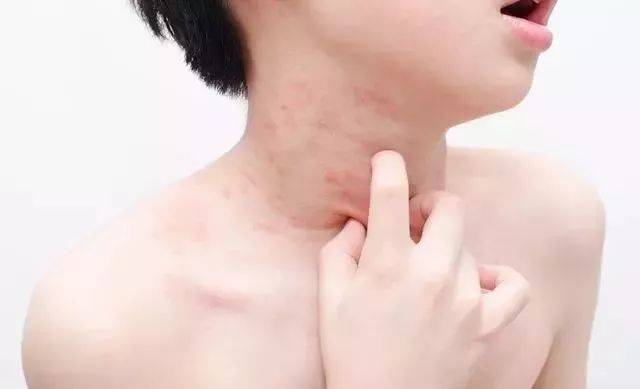 荨麻疹lge是正常的 慢性荨麻疹如何调理