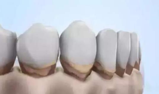 引起牙齦萎縮的原因有哪些？牙齦萎縮吃什么好？