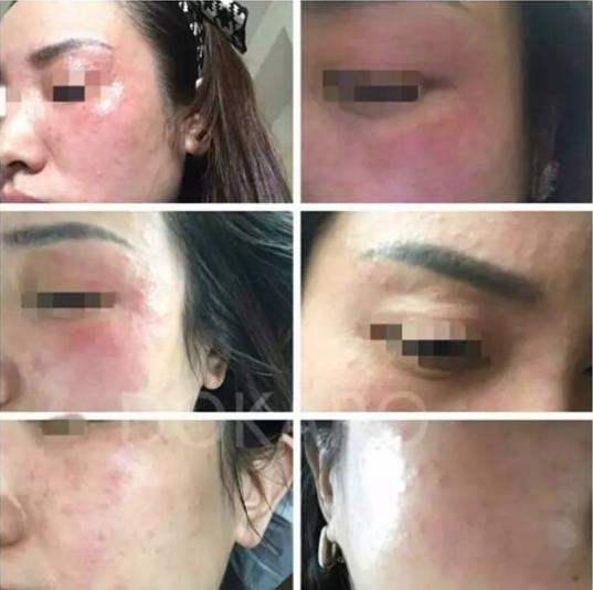 還在煩惱痘痘怎么治？看這里，植晰教你科學祛痘