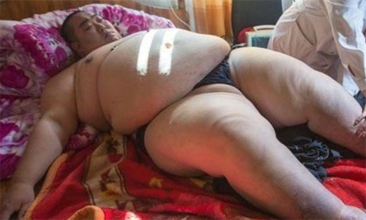 男子结扎后致体重达520斤 中国最胖的人